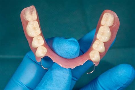 Partial dentures robina Conventional dentures are removable (removable partial denture or complete denture)